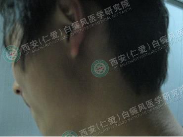 得了白癜风会有什么危害 得了白癜风会有什么危害