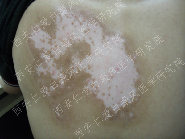 白癜风对人体的危害有哪些呢 白癜风对人体的危害有哪些呢