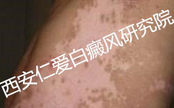 夏季白癜风患者如何洗澡 夏季白癜风患者如何洗澡