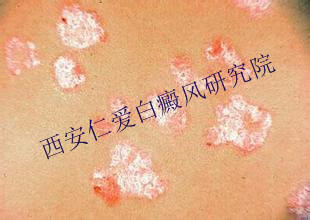 白癜风的预防常识有哪些 白癜风的预防常识有哪些