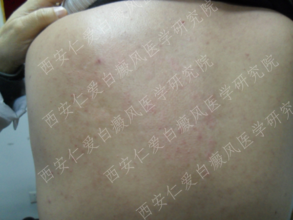 西安哪个医院治白癜风好