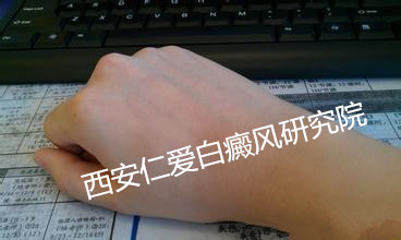早期白癜风检查要注意什么 早期白癜风检查要注意什么